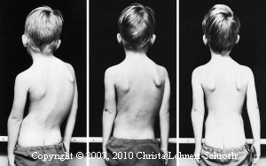 Boy After Three Dimensional Scoliosis Treament