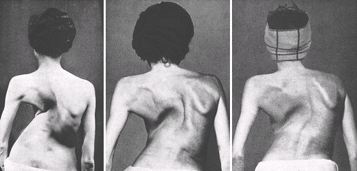 24-year-old woman severe scoliosis atrophied left